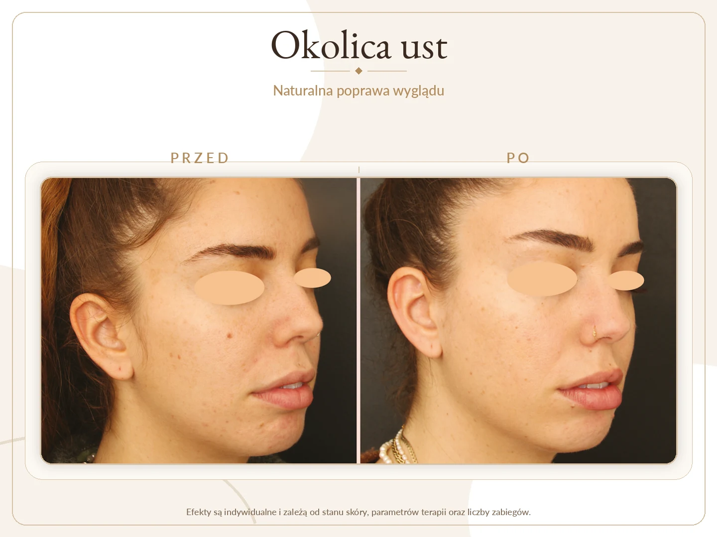 Okolica ust przed i po zabiegu — naturalna poprawa wyglądu skóry