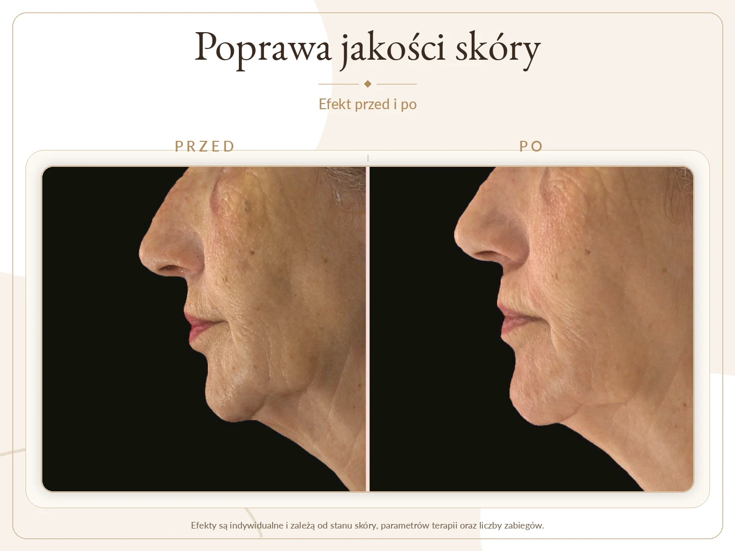 Poprawa jakości skóry przed i po zabiegu Alma Harmony Laserowe Sekrety