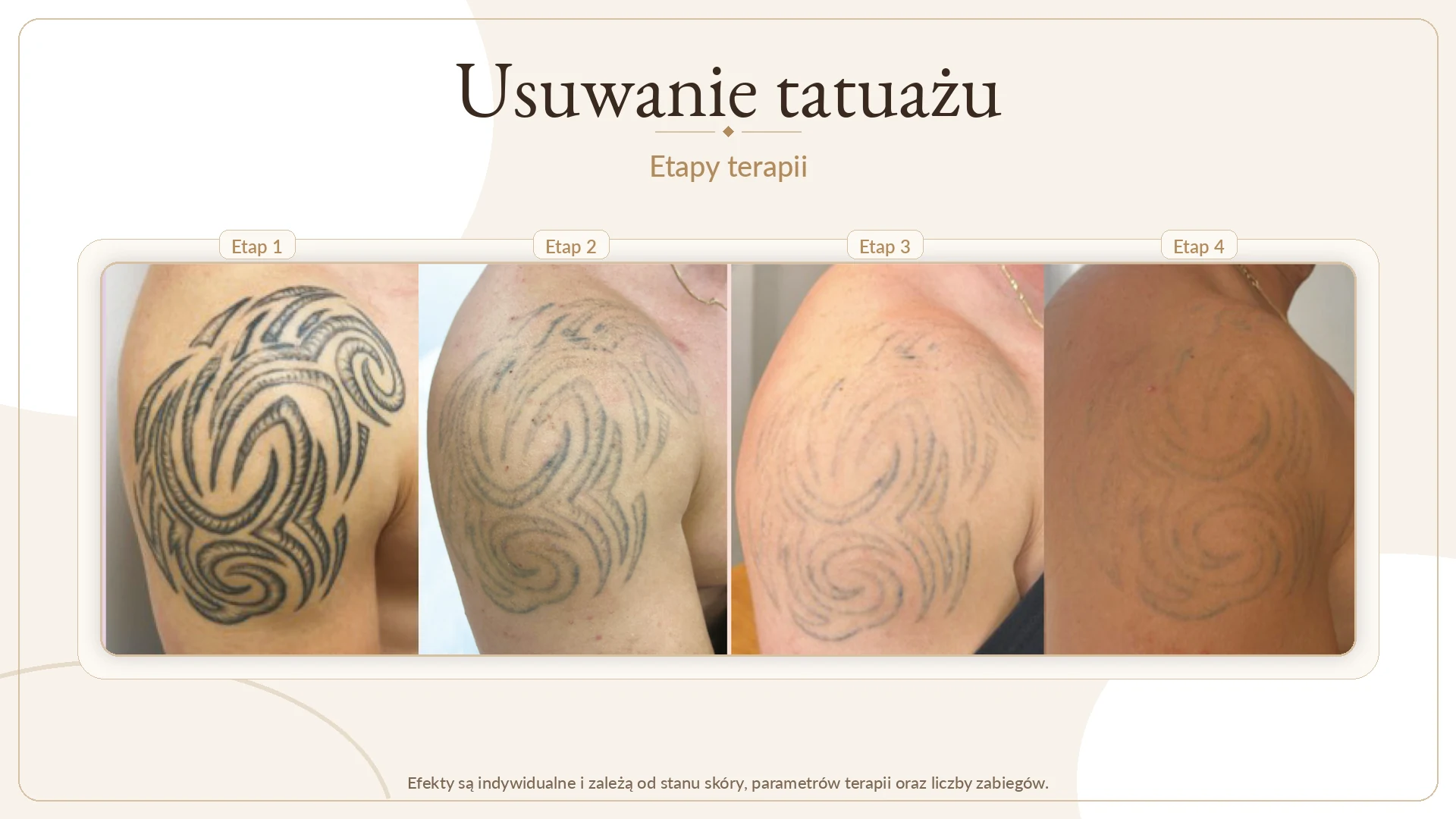 Usuwanie tatuażu laserem Alma Harmony — etapy terapii, Laserowe Sekrety Krosno