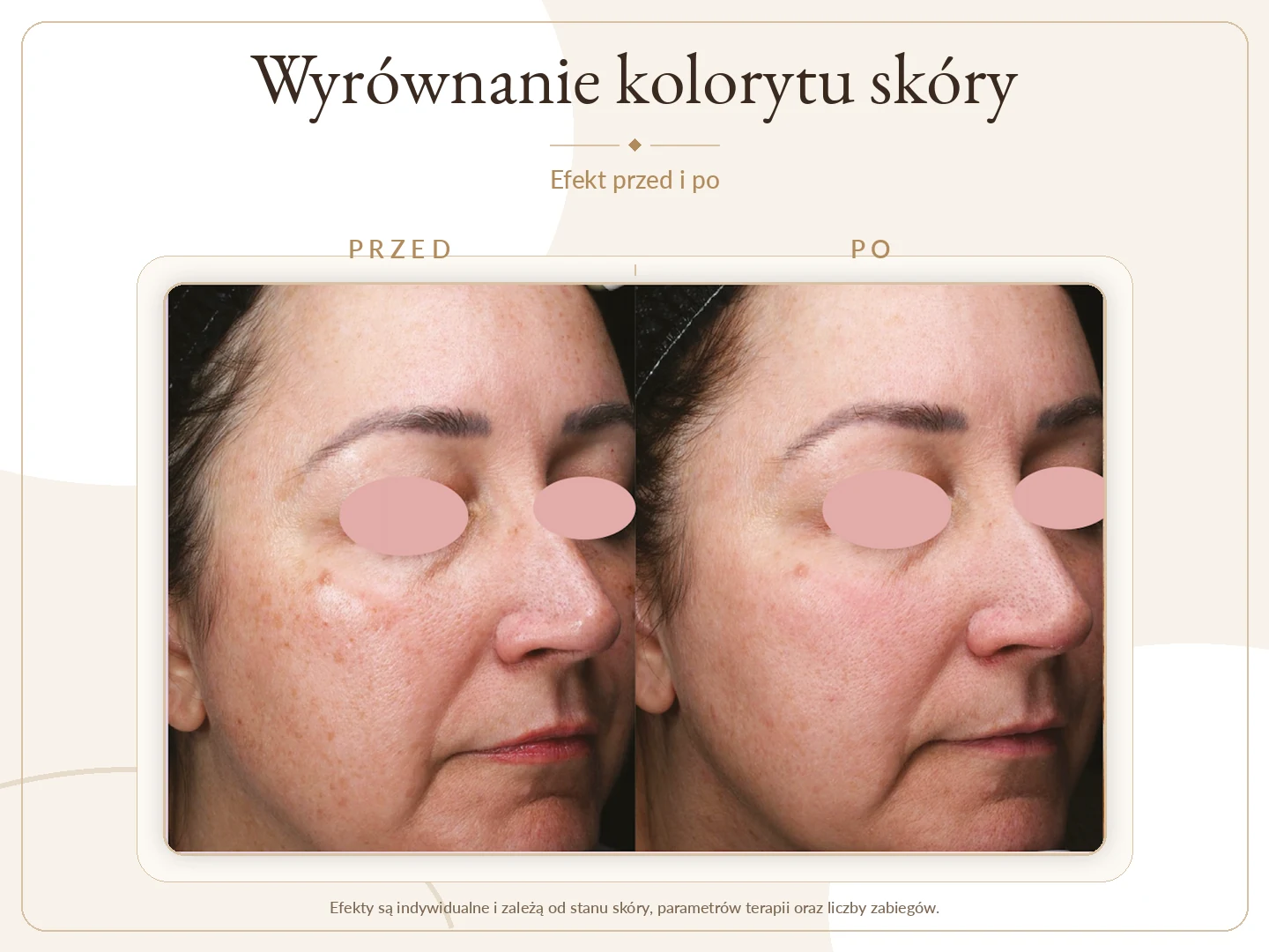 Wyrównanie kolorytu skóry przed i po zabiegu Alma Harmony Krosno